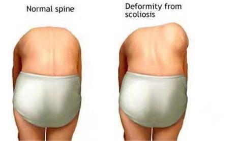 脊柱侧弯，怎样用瑜伽来改善？试试这些瑜伽动作