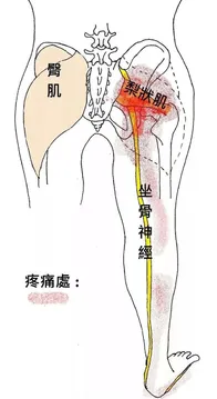 梨状肌，可能是坐骨神经痛和下背部痛的根源，一定要重视起来