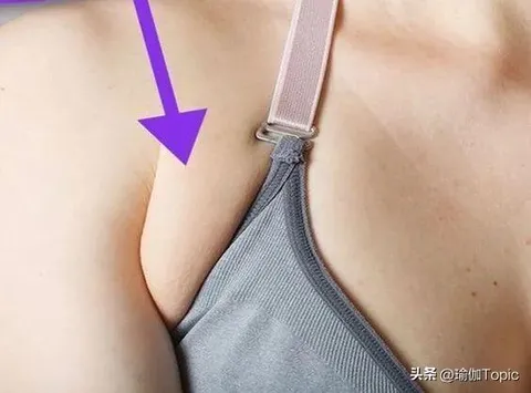 女生为何容易长副乳？